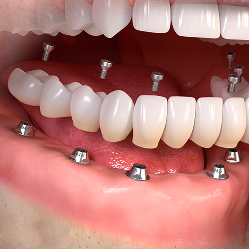 verkouden worden redactioneel Verstelbaar Implantologie | Tandheelkunde Venray